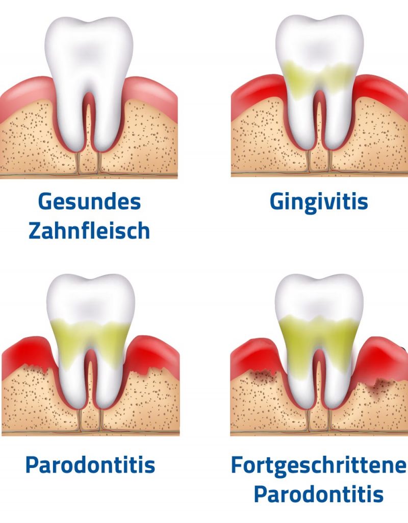Parodontose Parodontitis Bonn Parodontitis Behandlung